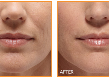 Juvederm treatments - Before & After